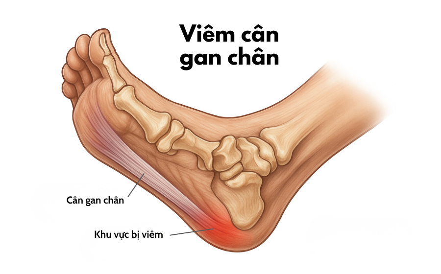 Viêm cân gan chân